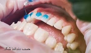 چسب های دندانپزشکی